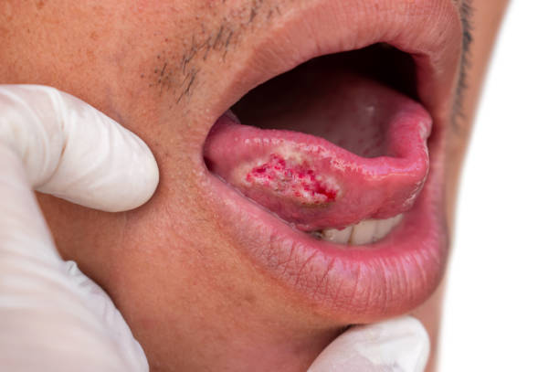 Oral cancer surgery Raipur