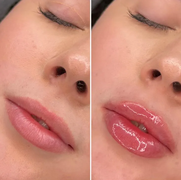 butterfly lips before and after
